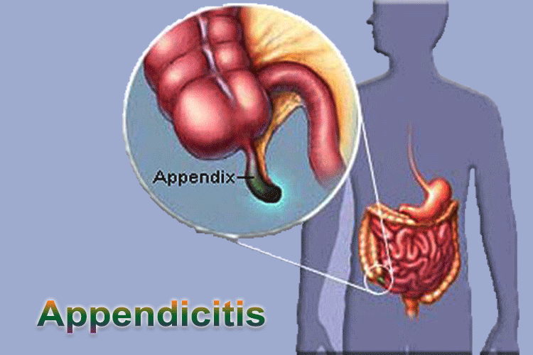 Appendicitis এপেনডিসাইটিস