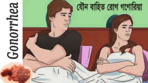 Gonorrhea homeopathic treatment গণোরিয়া