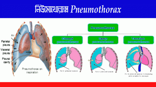 নিউমোথোরাক্স (Pneumothorax)