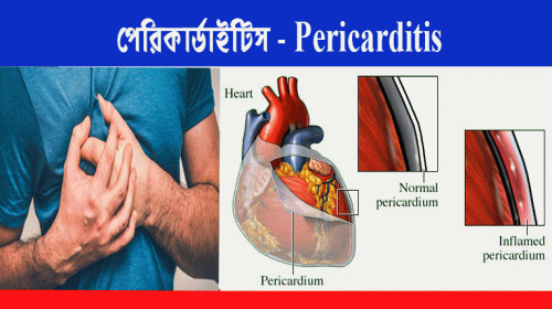 পেরিকার্ডাইটিস-Pericarditis